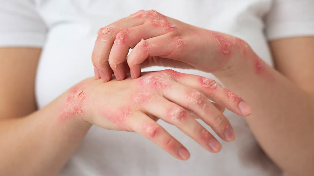 Understanding Psoriasis and the Impact of Harsh Chemicals in Commercial Soaps